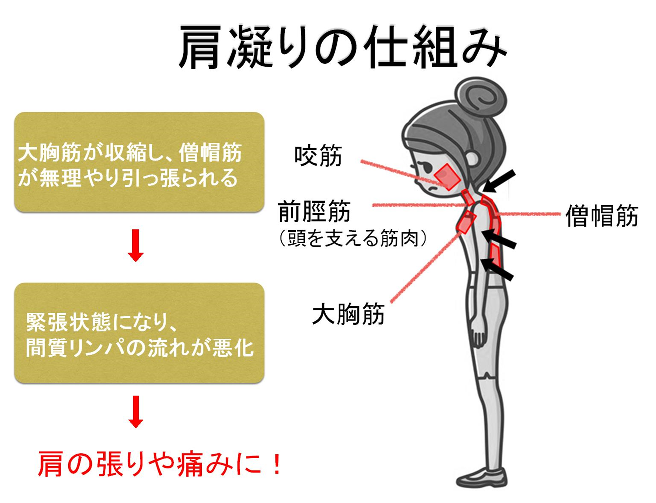 肩こりの原因 さとう式リンパケア 整体 糸脱毛 ぬくもりの糸 愛知県海部郡飛島村 名古屋